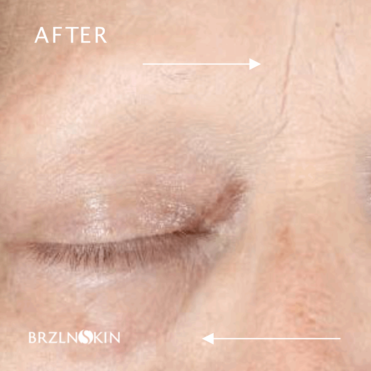 BRAZILIAN FACELIFT KIT 30% OFF with INTROSPECIAL Code