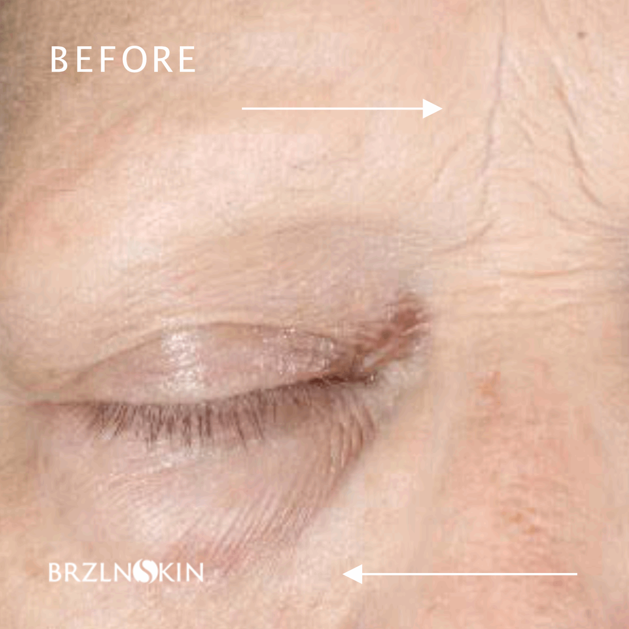 BRAZILIAN FACELIFT KIT 30% OFF with INTROSPECIAL Code