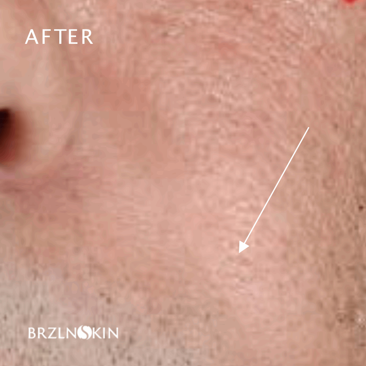 BRAZILIAN FACELIFT KIT 30% OFF with INTROSPECIAL Code