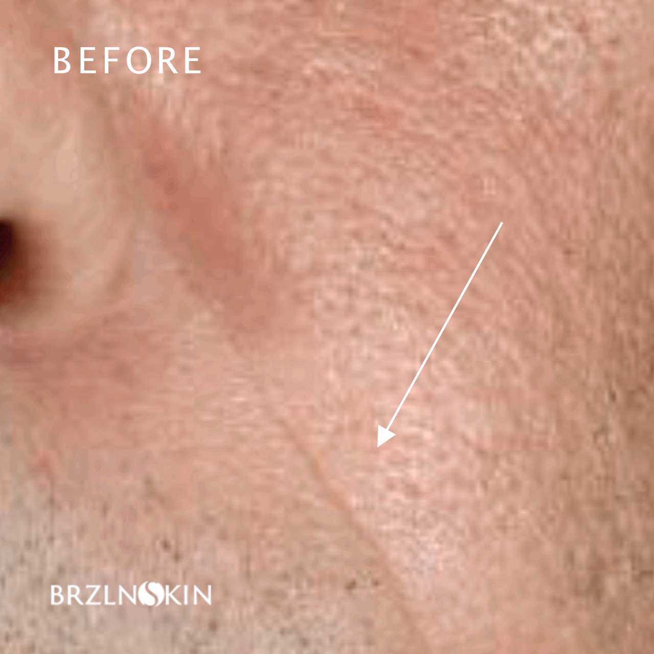 BRAZILIAN FACELIFT KIT 30% OFF with INTROSPECIAL Code