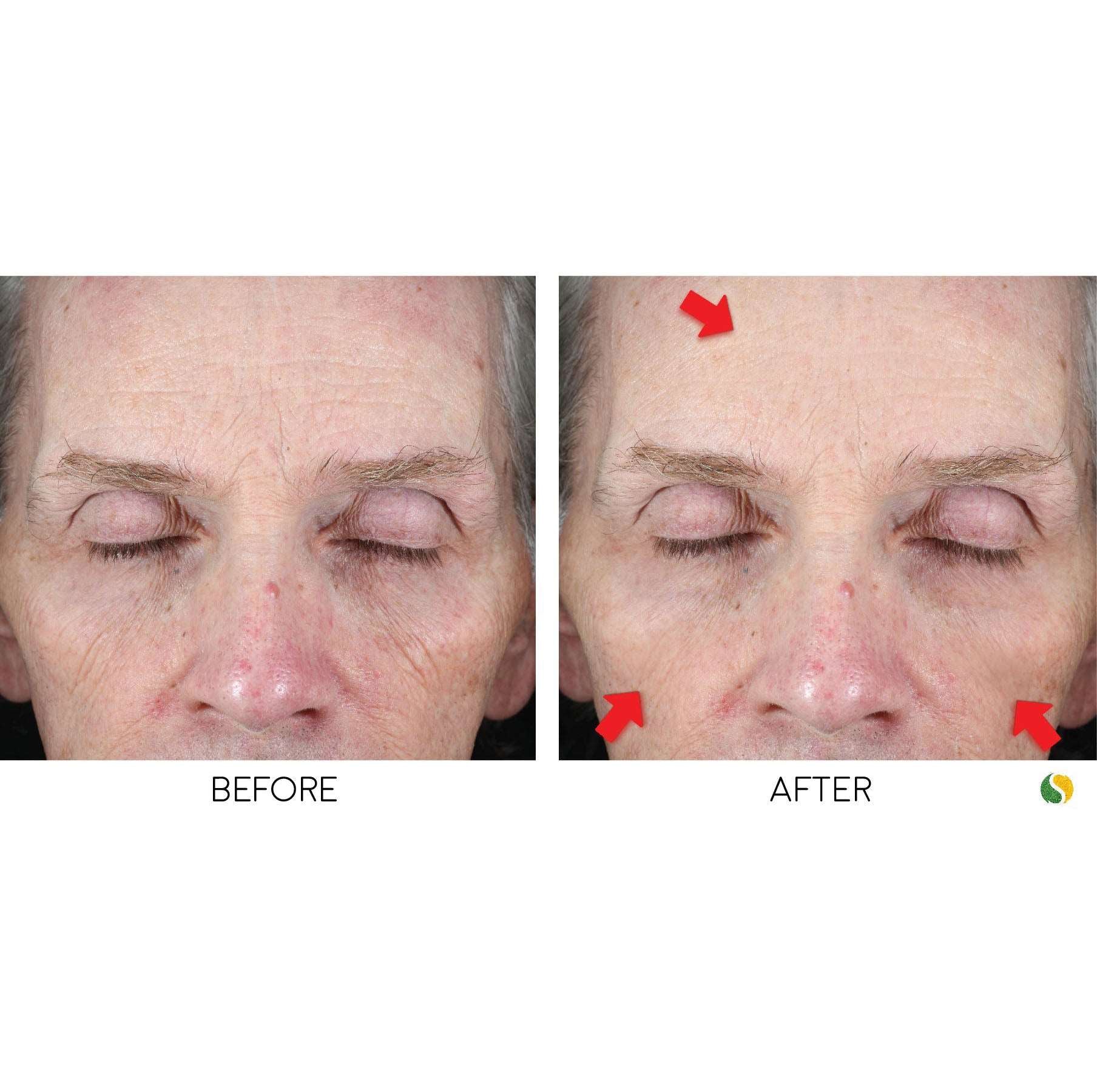 BRAZILIAN FACELIFT KIT - A clinically-tested revolutionary 