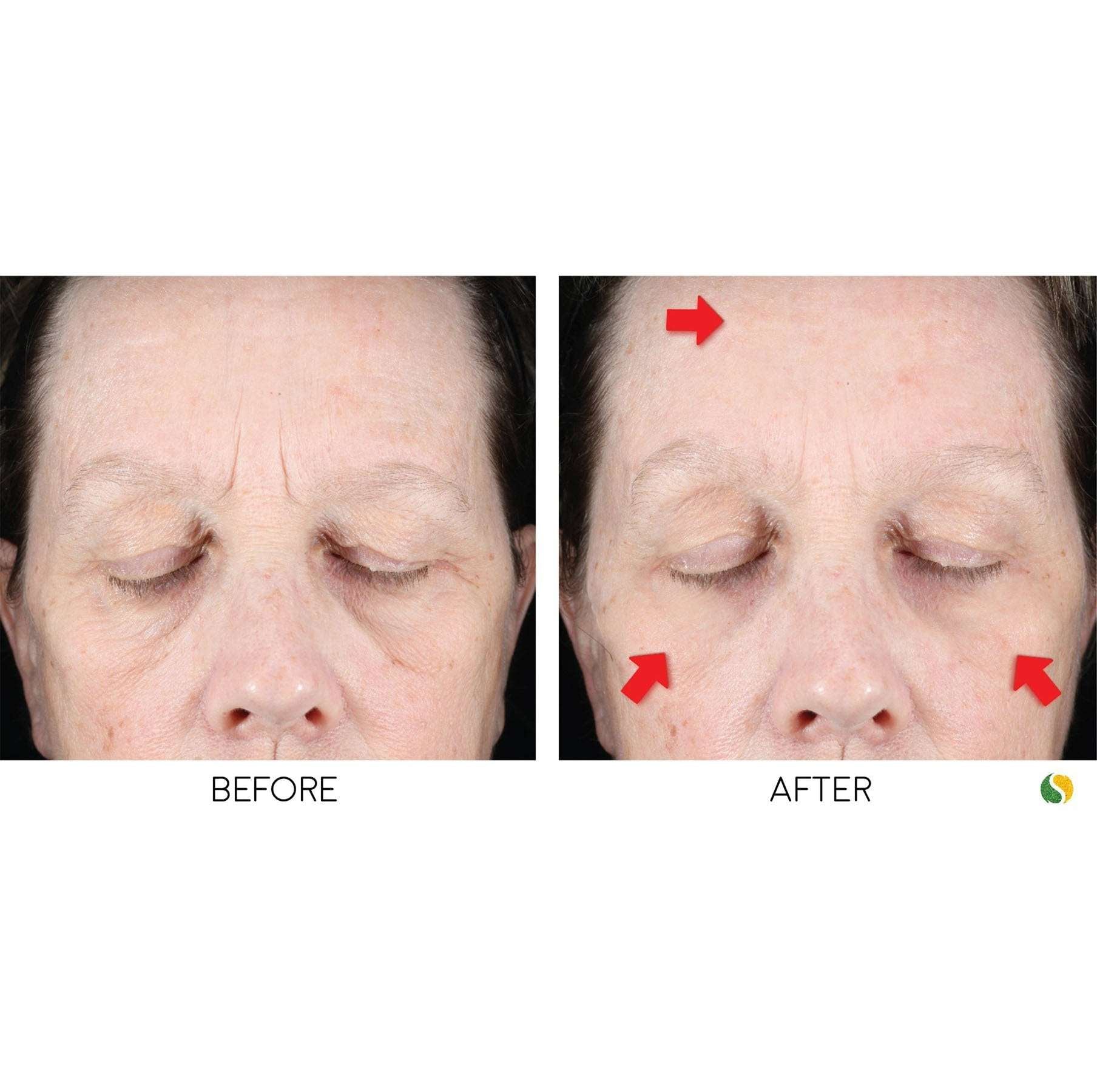 BRAZILIAN FACELIFT KIT - A clinically-tested revolutionary