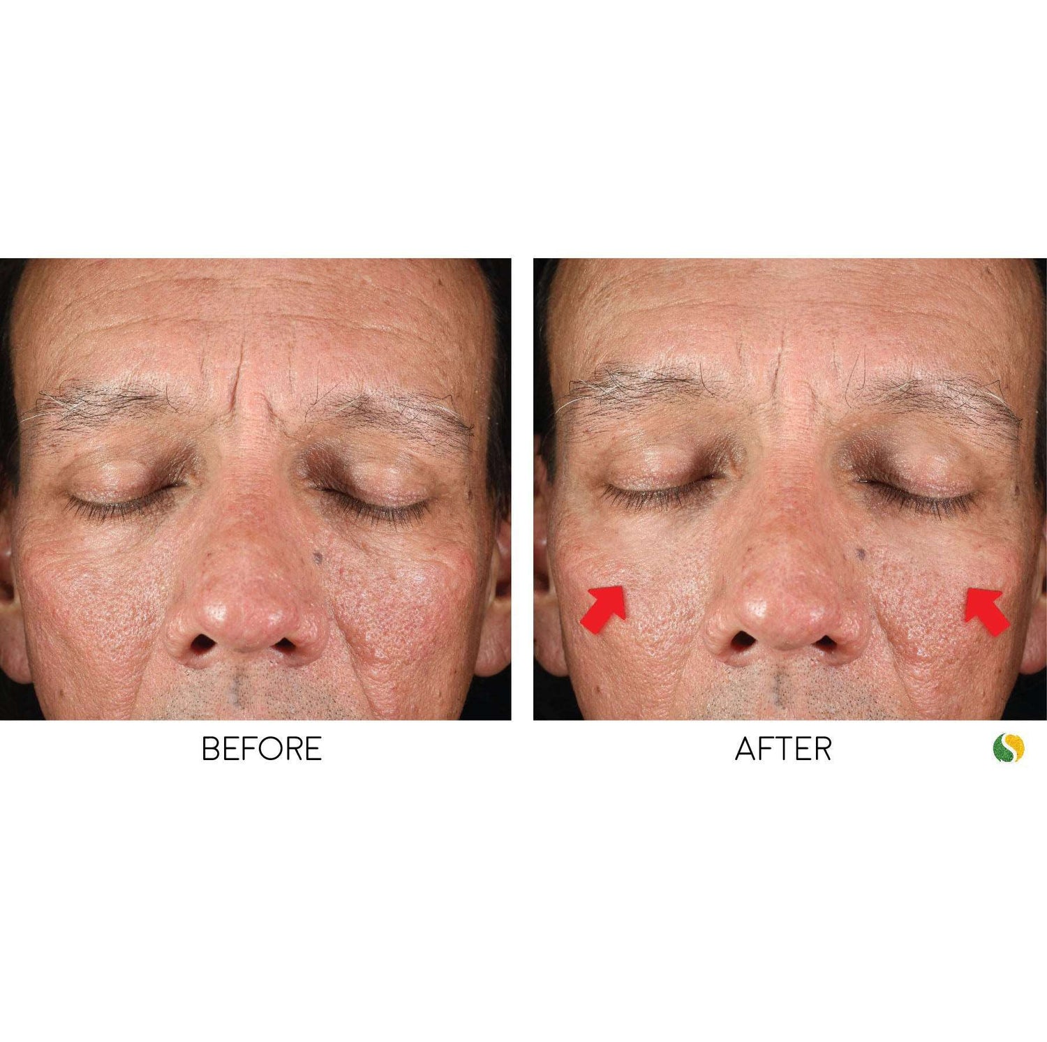 BRAZILIAN FACELIFT KIT - A clinically-tested revolutionary 