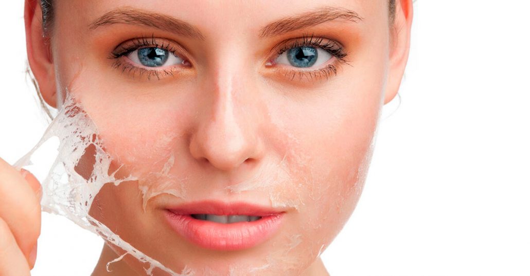 chemical peel